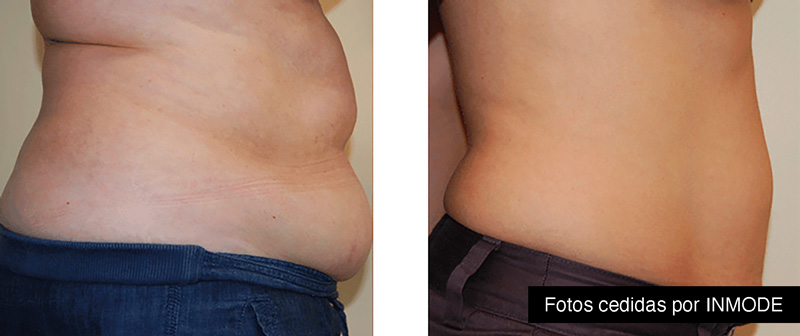 tratamiento bodytite flacidez antes-después
