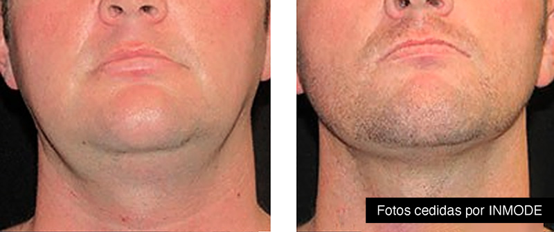 reducción de papada en hombres donostia