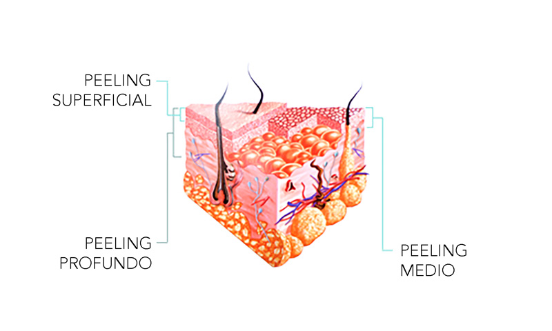 eliminación de manchas en la piel mediante peelings donostia